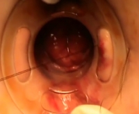 H τεχνική TST-STARR στην αντιμετώπιση της αποφρακτικής δυσκοιλιότητας