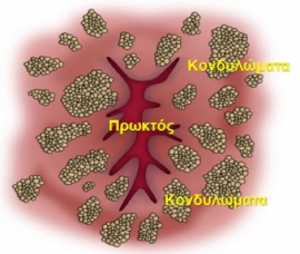 Κονδυλώματα πρωκτού